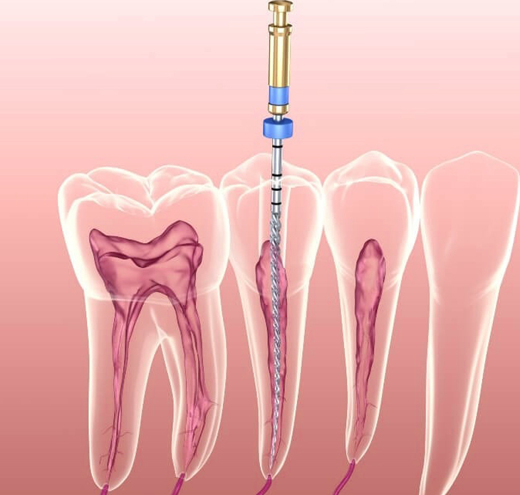 شعبة علاج الجذور